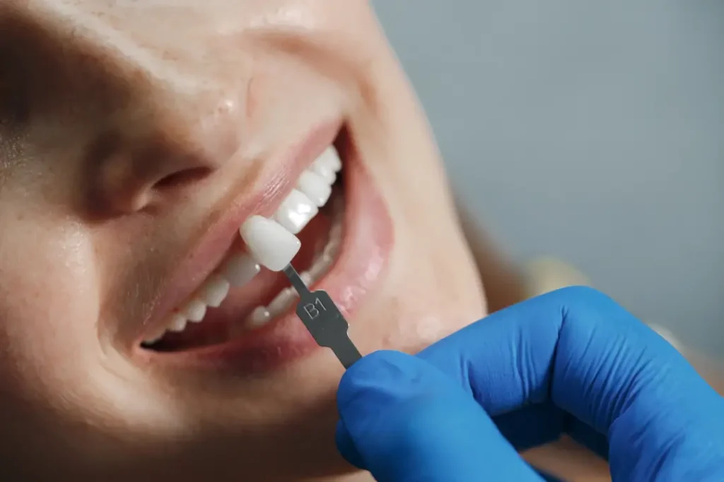 Carillas dentales en Sevilla - Solución estética para tu sonrisa