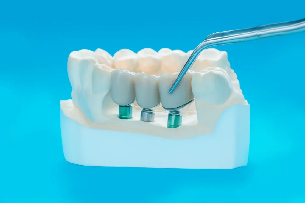 implante-all-in-four-sevilla