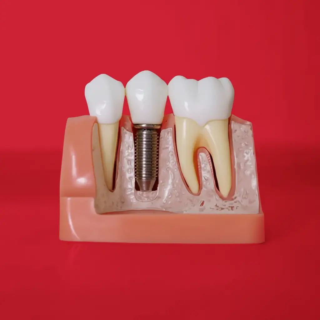 Implantes dentales en Sevilla - Recupera tu sonrisa con Orthodontic