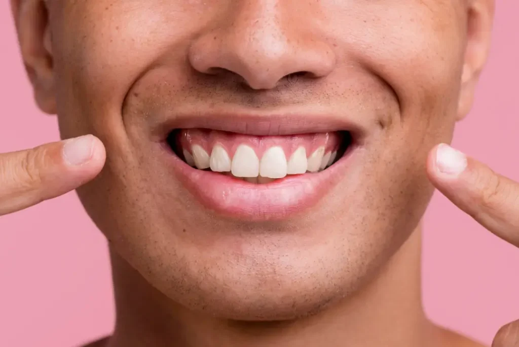 sonrisa-gingival-sevilla