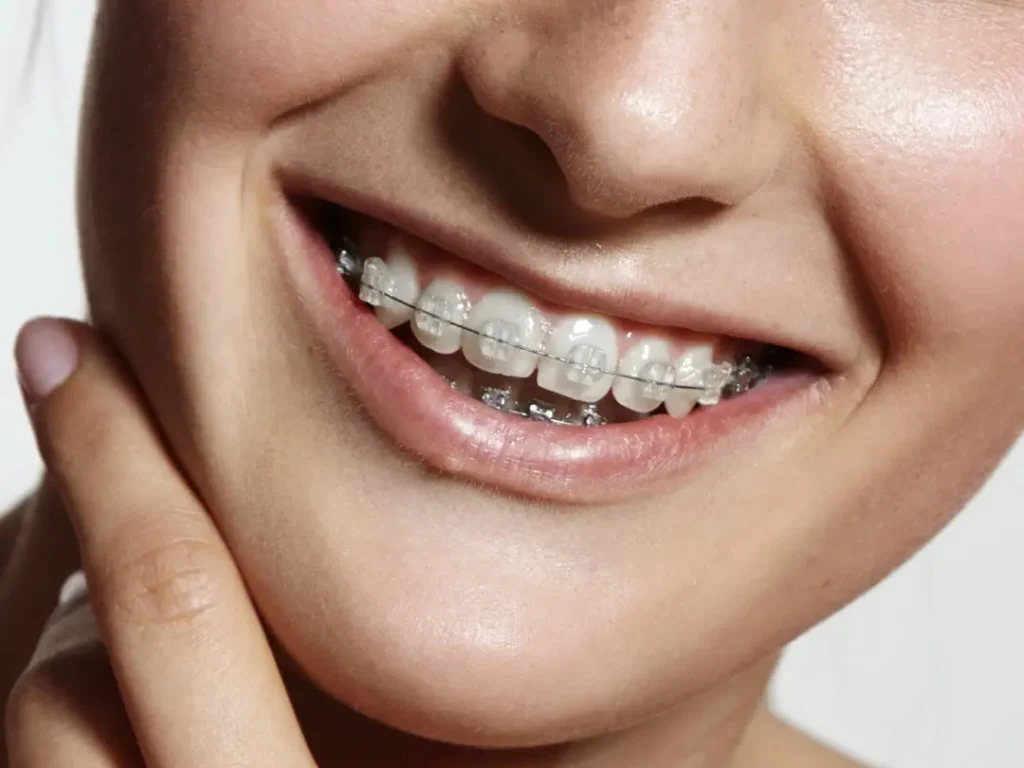 brackets-esteticos-comodidad