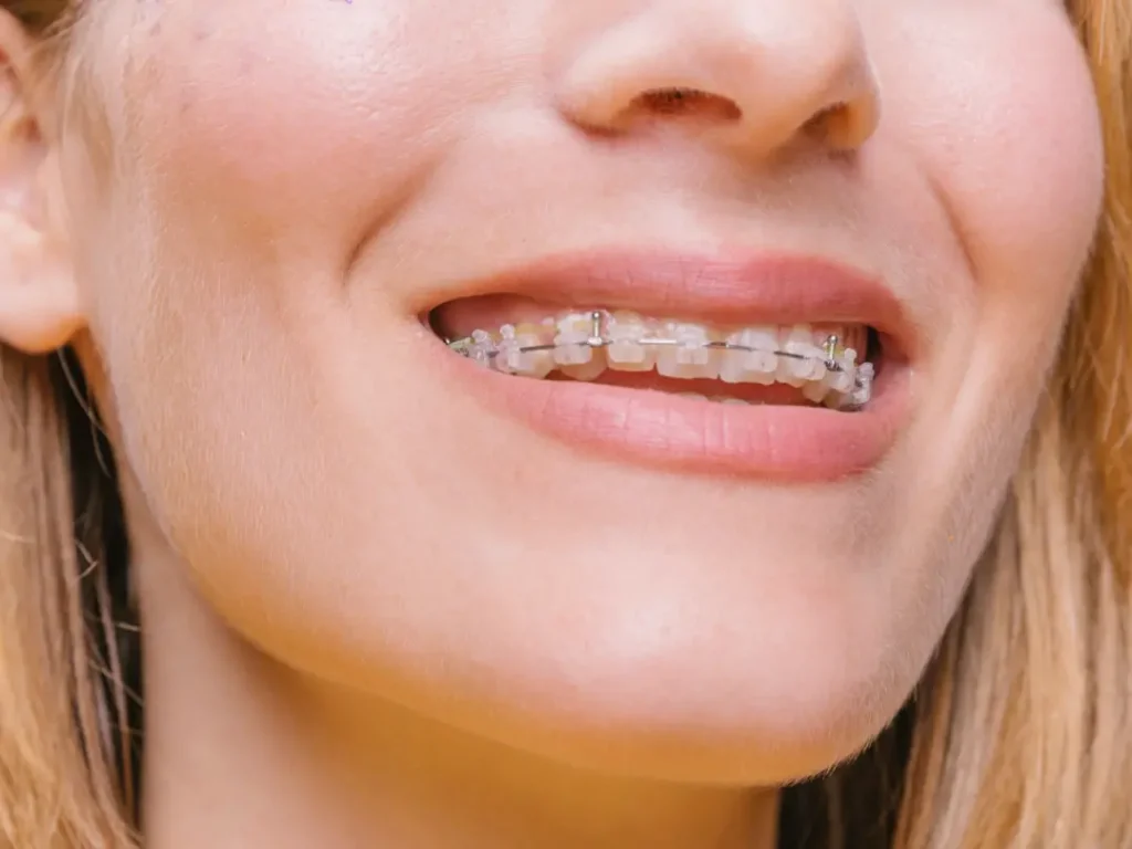 Brackets estéticos en Sevilla