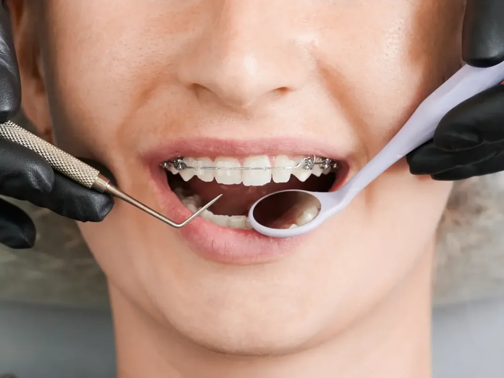 Brackets de porcelana en Dos Hermanas