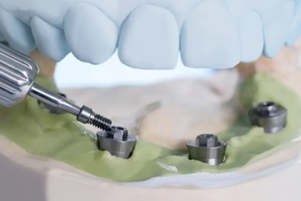 Implantes All-on-4 en Sevilla