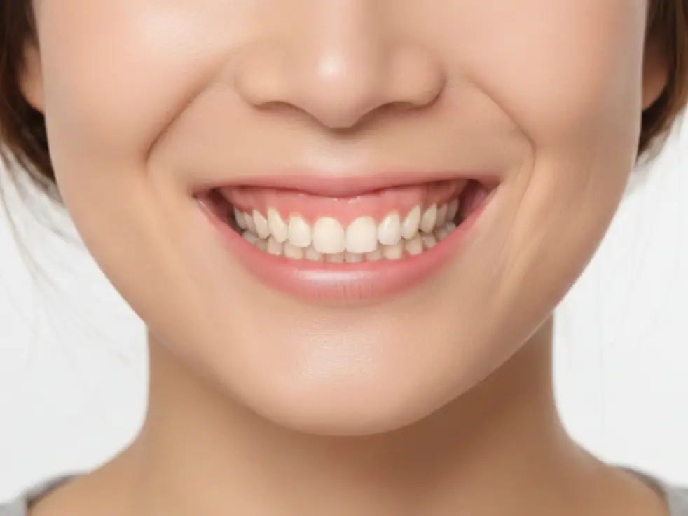 Tratamiento de sonrisa gingival en Sevilla