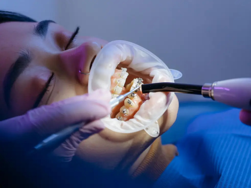 Tratamiento odontológico personalizado para sonrisa gingival en Sevilla