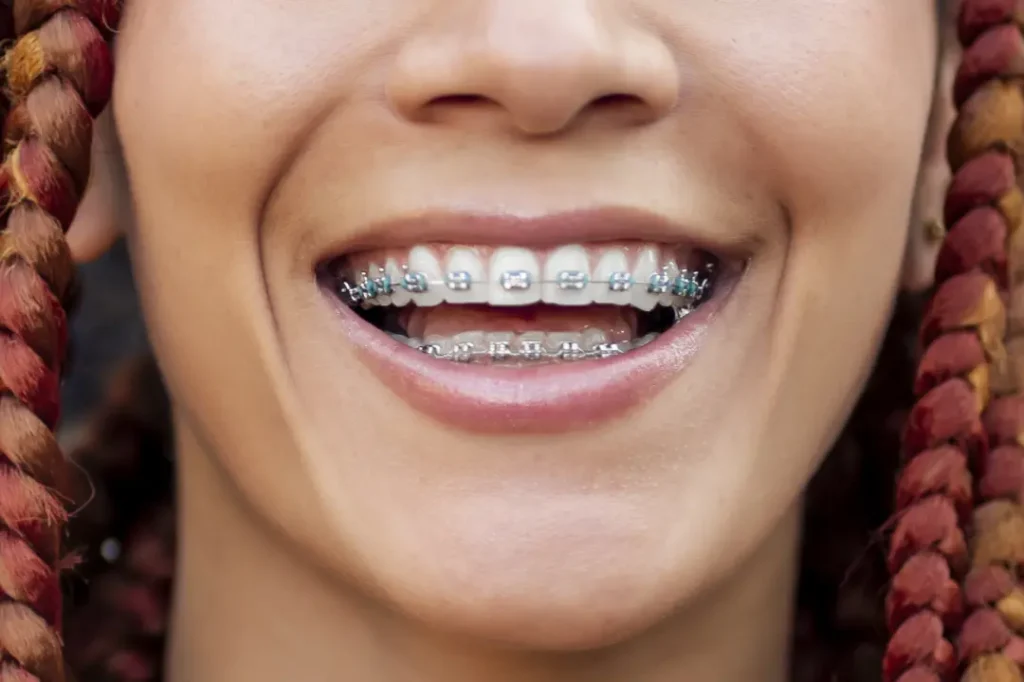 Tratamientos complementarios para la recesión de encías