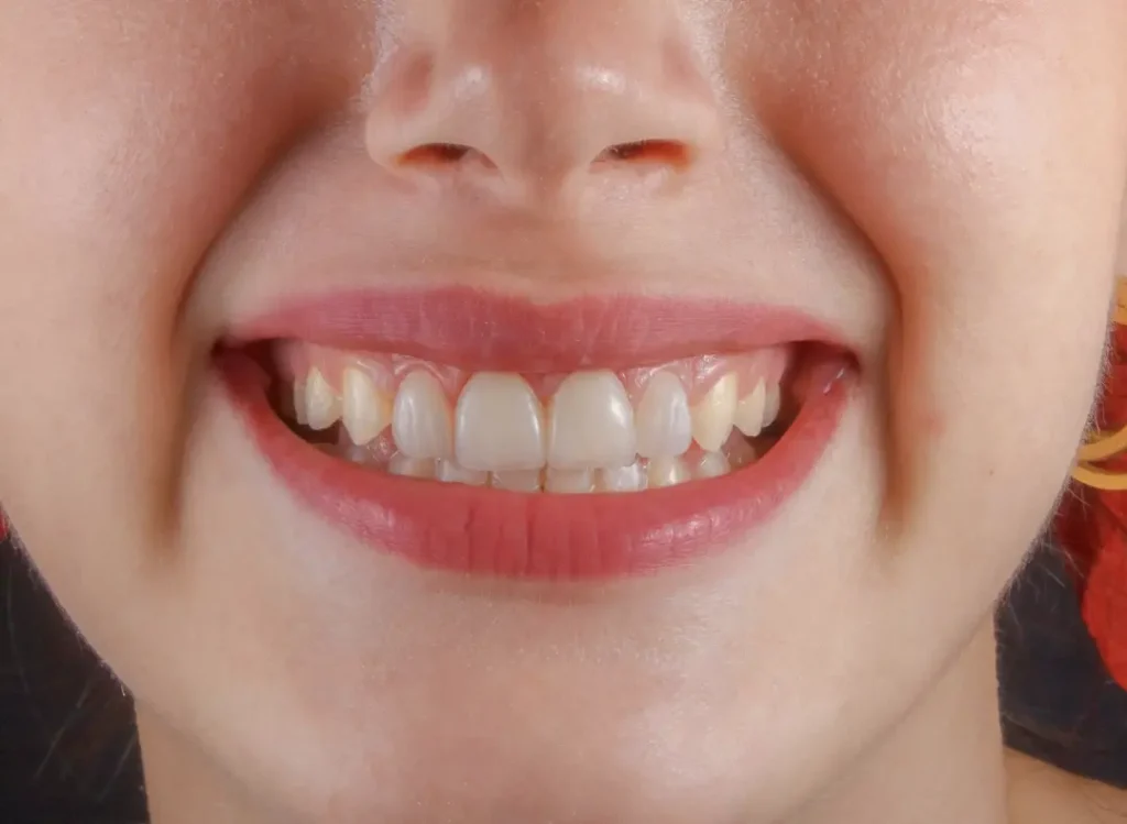 Prevención a largo plazo de la periodoncia en Sevilla